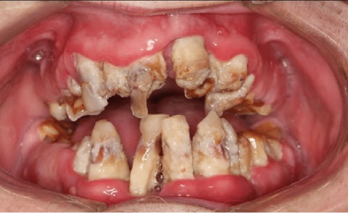 smertefri-behandling-tannlege